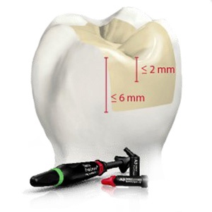 For deeper cavities (up to 8 mm), you can use a 4-mm bulk-fill material: