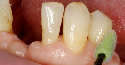 Gezielter Schutz der natürlichen Restzähne bei Zahnersatz (Bild: Dr. F. Zimmerling)