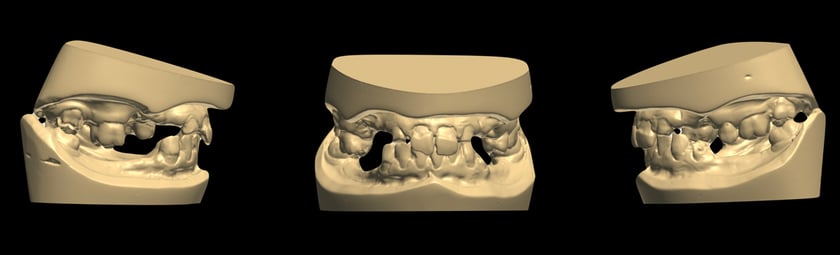 Digitalized study models in the Digital Denture software