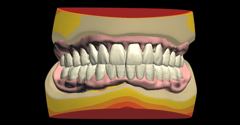 The program automatically sets up the teeth according to the model analysis. Adjustments can be made if necessary.