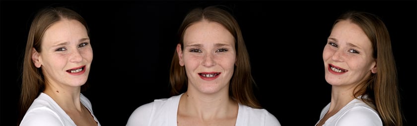 I pochi denti di Andrea ancora presenti non sono recuperabili. Nonostante il suo timore per il trattamento complesso, con Digital Denture è stato possibile indicarle una via d'uscita.