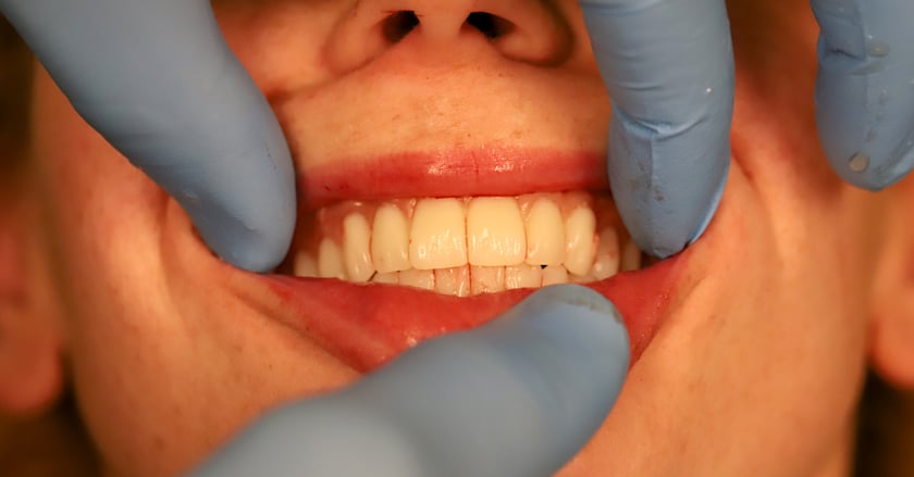 La intervención quirúrgica se hizo con anestesia general. Las prótesis temporales se fabricaron previamente con el sistema Digital Denture, y se colocaron directamente en la boca de la paciente.