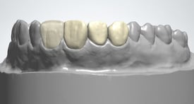 The digital design of restorations is made easy by the software.