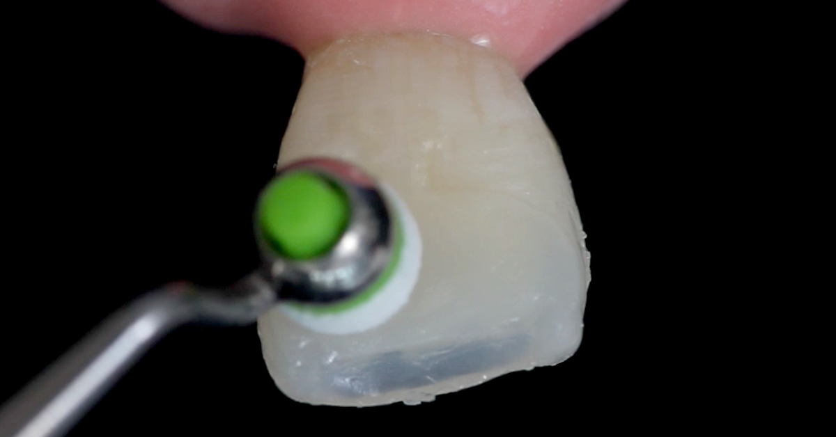 Video: Here is how you can achieve natural-looking restorations in the anterior region