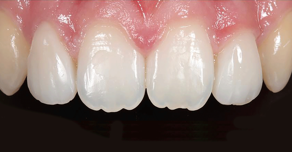 The ideal choice for natural-looking restorations