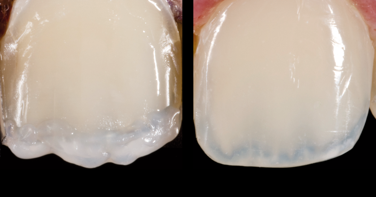 Practical tip: How to incorporate special optical effects in restorations!