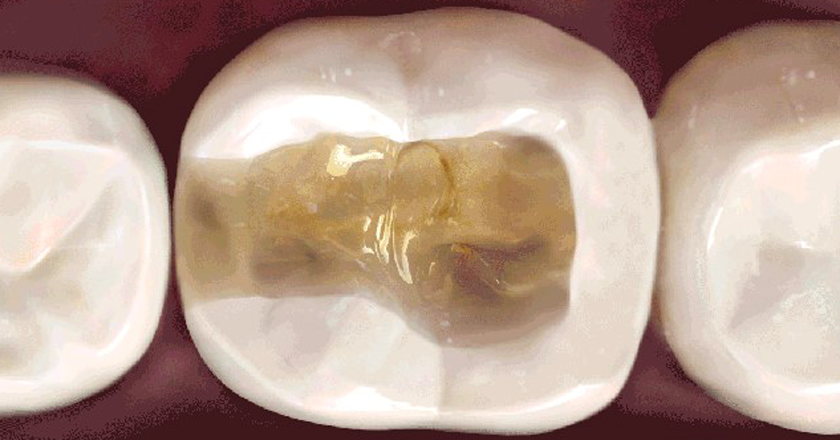 The one indispensable trick you need to mask severely stained dentin in posterior restorations