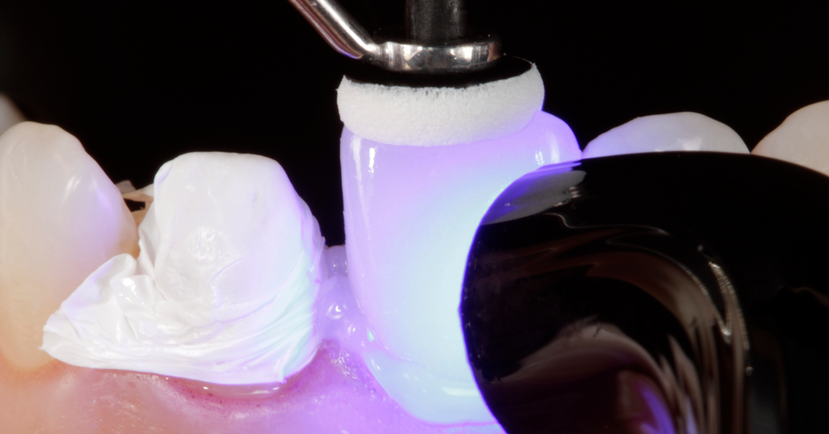 Practical tip: How to successfully cement highly esthetic restorations