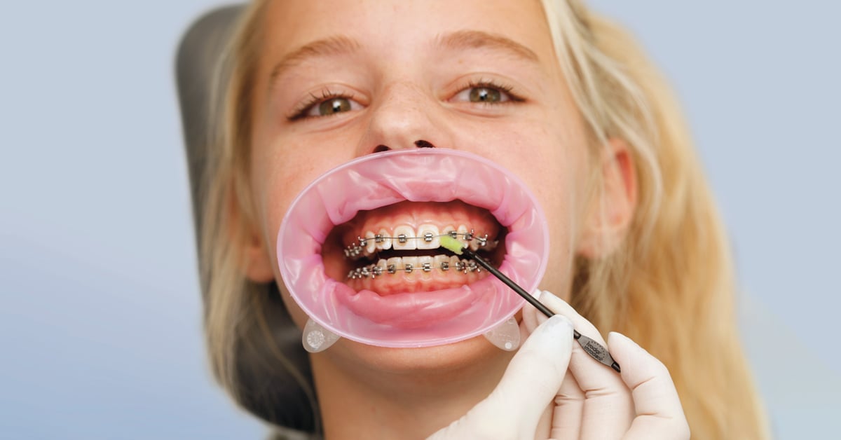 How to supply orthodontic patients with fluoride?