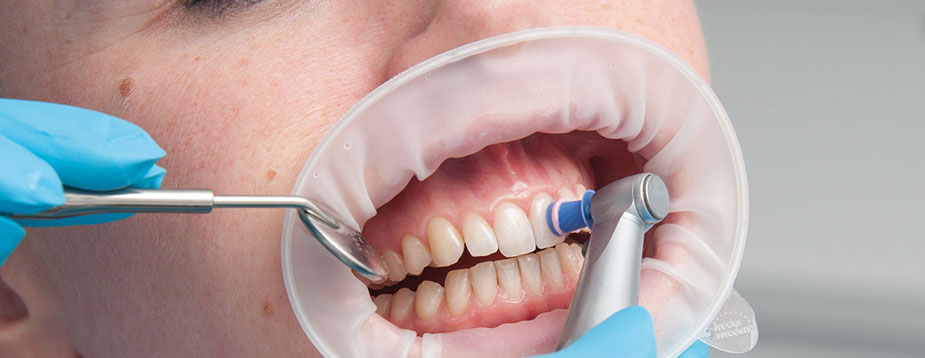 Pulizia dentale professionale: delicata, ma efficace!