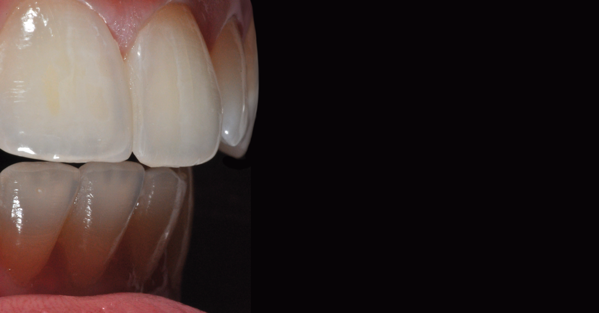 Four red hot tips for creating esthetic anterior restorations