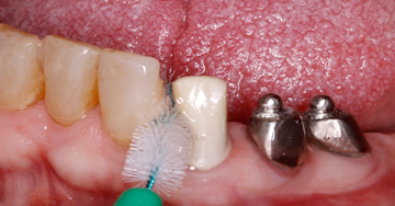 Five tips on how to treat patients with periimplant mucositis